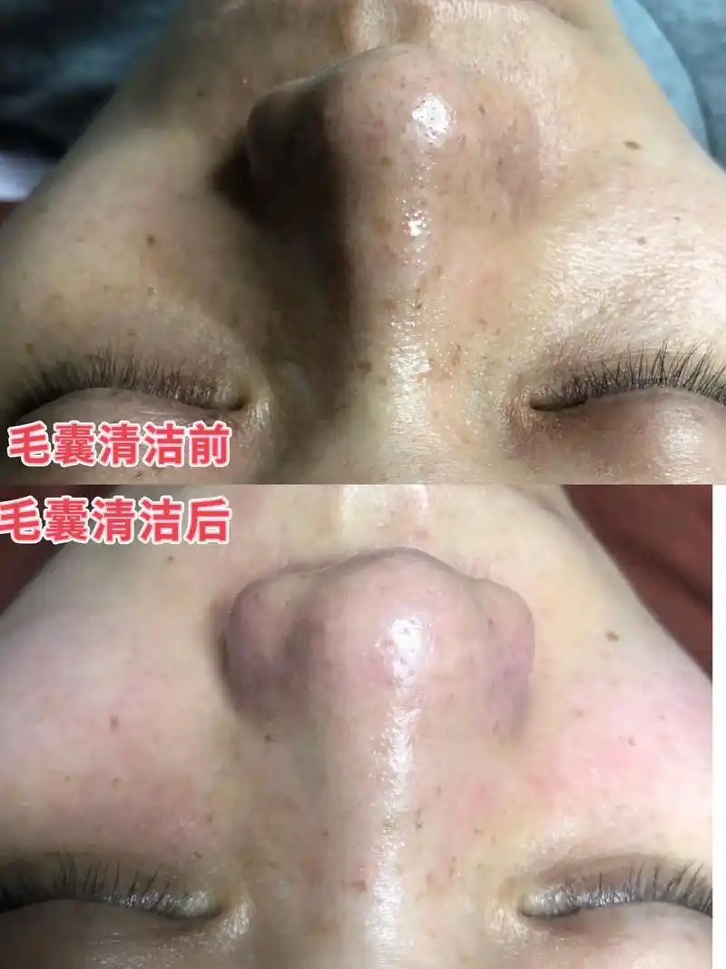 毛囊清洁术 新鲜出炉的毛囊清洁,好的皮肤必须建立在肌肤正常 - 兑趑