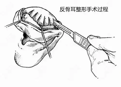到底耳骨外翻怎么矫正呢?附上反骨耳矫正方法了解下
