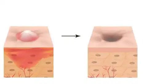 总结:皮脂膜一定要适当养护,破坏了这一层屏障,角质层也会受到破坏.