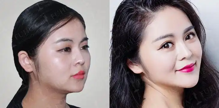 注射玻尿酸的魔力有多大?看了你就知道