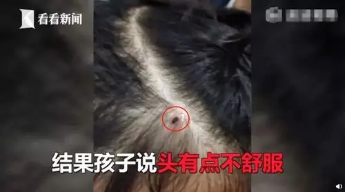 女孩户外玩耍头皮剧痛拨开头发一看竟是这种虫子