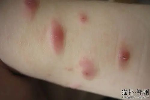 宝宝8个月,身上频繁出红色小疙瘩,去多家儿童医院诊断丘疹性荨麻疹