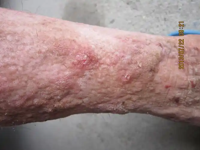 淤积性皮炎真菌感染还是什么病