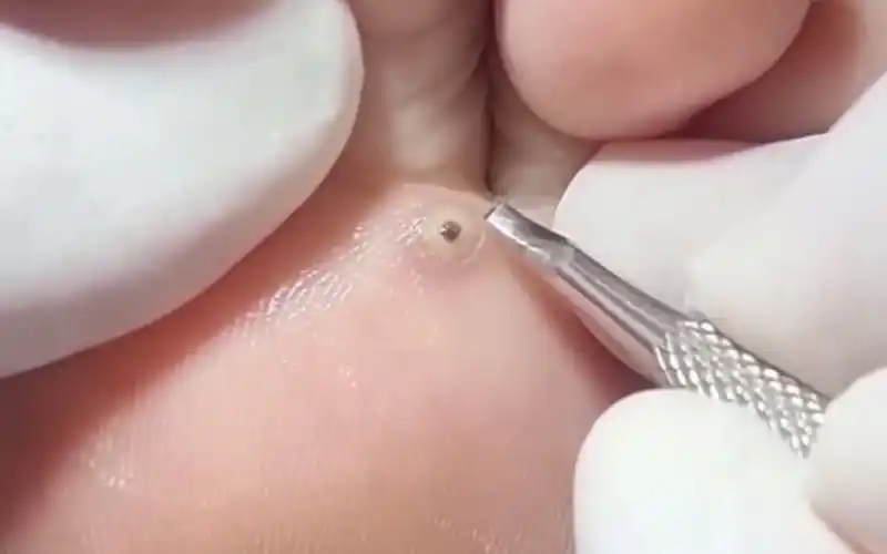 鸡眼早期症状有哪些(了解鸡眼早期症状)