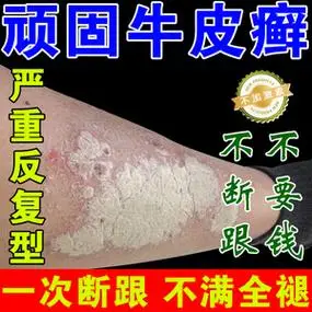 牛皮癣藓银屑病皮肤过敏湿疹手足癣头癣股体藓顽固性止痒专用药膏