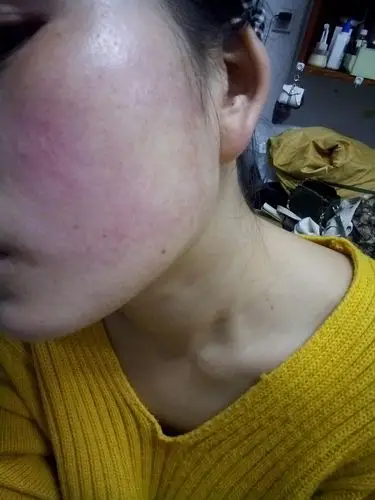 角质层薄,高原红,红血丝,过敏,各位大神救救我的脸啊0101