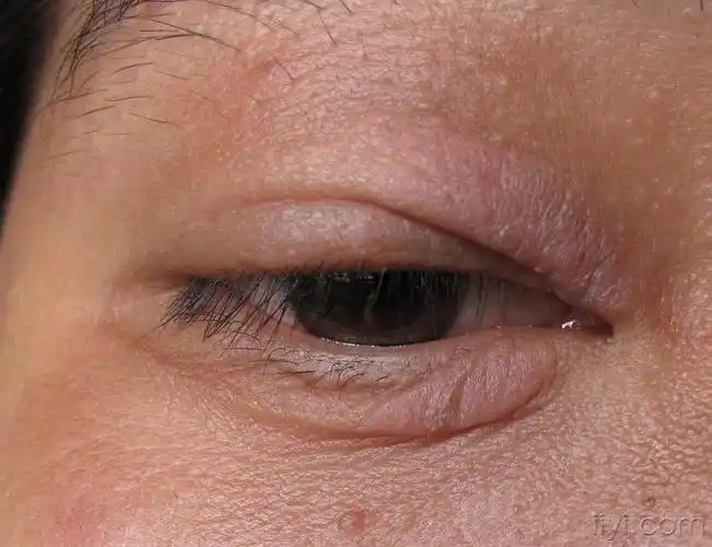 眼周皮疹三年 - 皮肤及性传播疾病讨论版 - 爱爱医医学论坛