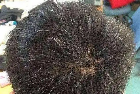 白发长在前额两鬓和后脑勺,说明了什么