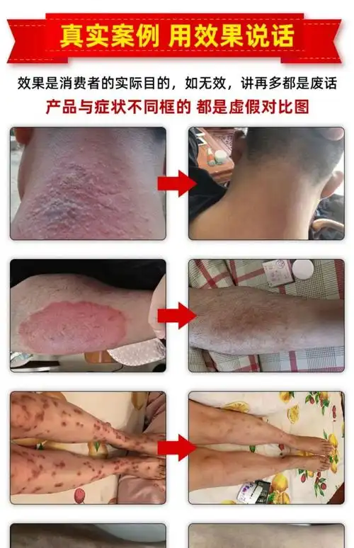 紫椒癣町酊藓顽固性膏体股癣专用老偏方 发3盒(轻度患者)【图片 价格