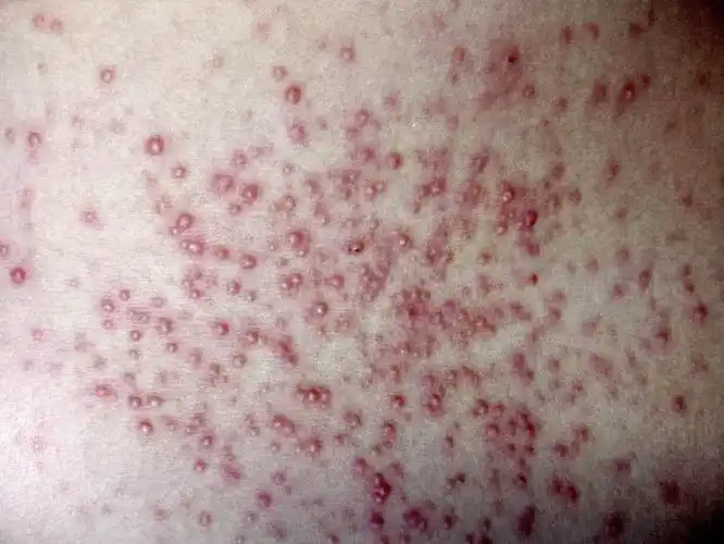 前胸后背,头皮,私处反复长红疙瘩,小心是毛囊炎作祟|毛囊炎_新浪财经