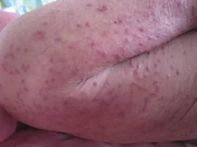 孕妇疥疮初期腹部皮肤症状图片