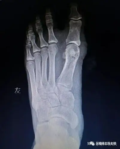 大脚骨拇外翻矫形手术