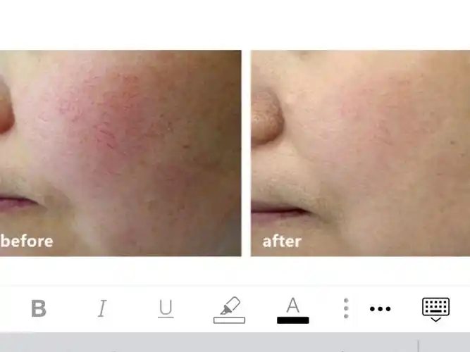 光子嫩肤祛红血丝的效果未免也太绝了