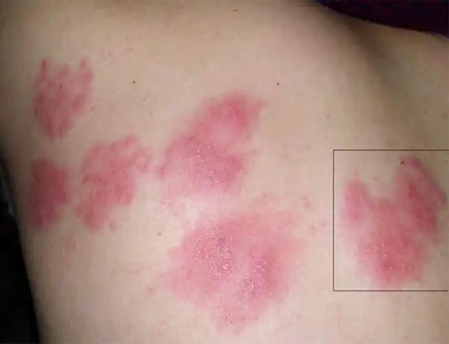 艾滋病片女银屑病的症状图片