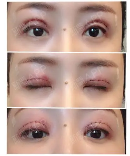 氧气4959261528075460切开双眼皮第1天美丽日记-新氧美容整形