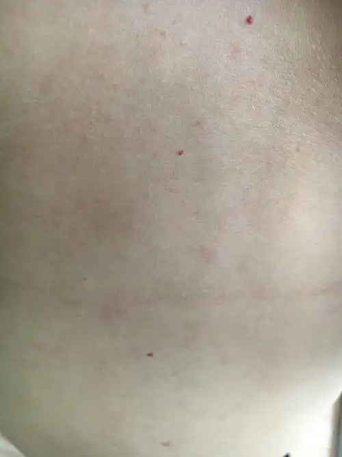 最近身上涨了很多这种小红点点,不痛不痒?