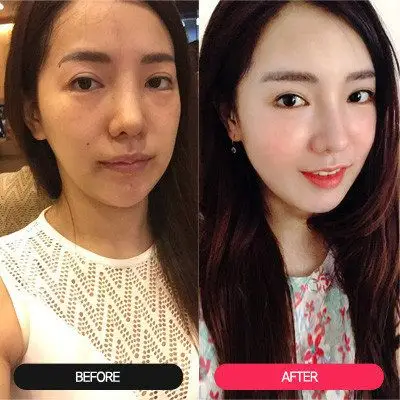 自体脂肪全脸填充失败了如何修复多久才能变平整