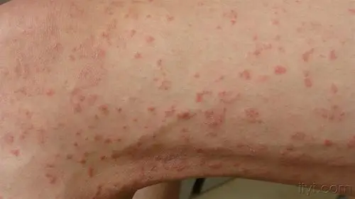 全身皮疹三周,诊断?