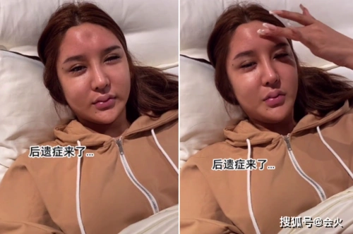 23岁女网红晒整容失败图!脑门凹陷一块太吓人,五官怪异眼睛抽搐