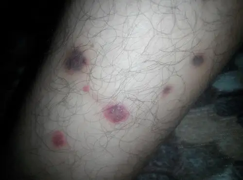 您好!医生!我的小腿上起了一些疙瘩,好了又起还出现了伤口出浓