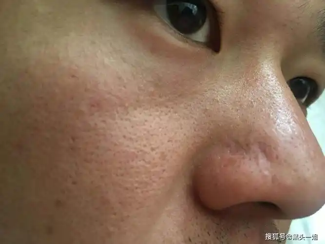 面部角质层厚,用什么护肤品去角质比较好?_皮肤