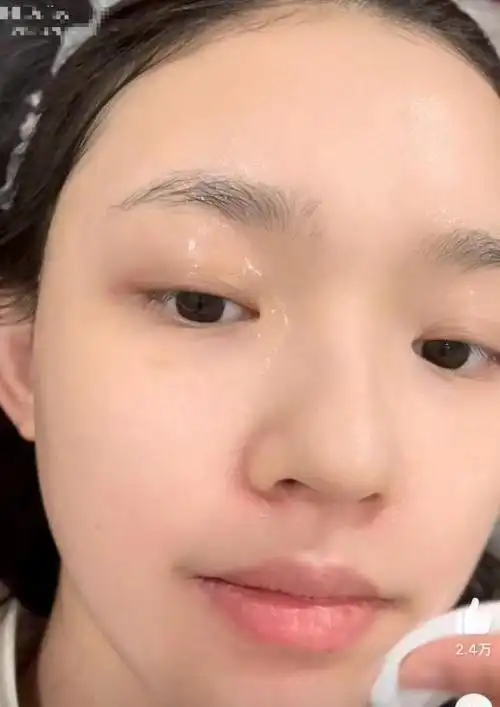 秦昊老婆跑韩国打水光针,56岁伊能静满脸针痕,感慨:真的好痛