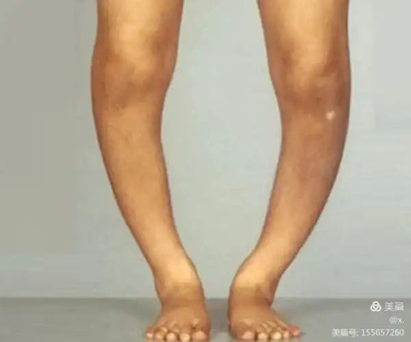 【南阳市儿童医学中心 儿二科 张龙】,小儿佝偻病你了解多少呢?