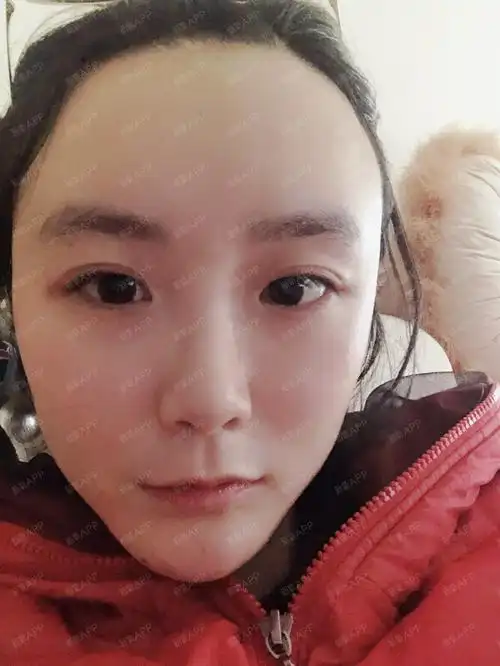 邓博虽然看着年轻,但是手术经验真的挺多的诶,脂肪填充的数量刚刚好