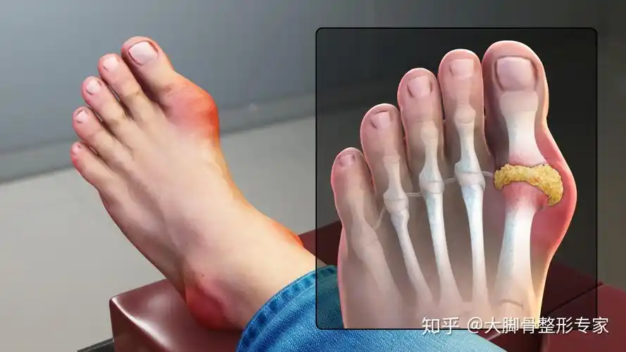 大脚骨整形专家 的想法: 虽然说#痛风# 也会导致第一跖趾关节凸起