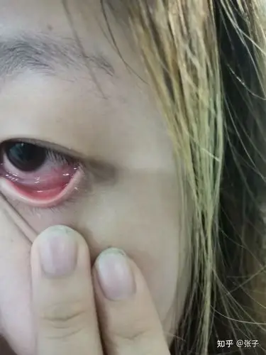 在玩手机,眼睛有点痒就揉了一下,就觉得下眼皮角膜有异物感,照镜子