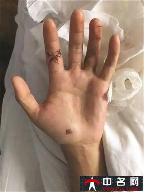 男子自剁两根手指 只因酒后与妻子吵架