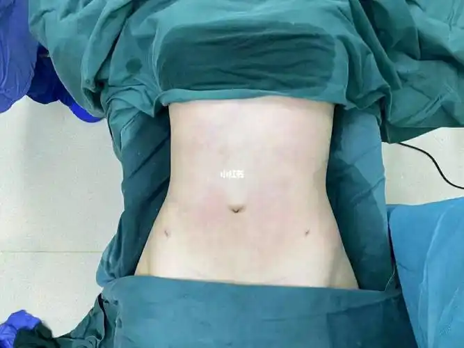 晒晒我的腰腹环吸,瘦了十厘米,效果很棒_腰腹_吸脂_美白_夏天去哪玩