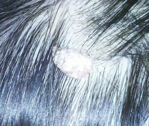 老人头皮外长了一块肉疙瘩(就只有一小部分连着头皮),已经好几年了,不