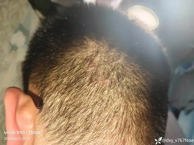 求问病例脂溢性皮炎毛囊炎