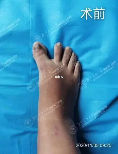 分享一例重度拇外翻做传统手术术后失败病例