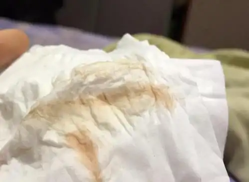 正常情况的下的白带是乳白色的糊状或透明的蛋清状,没有什么气味,如果