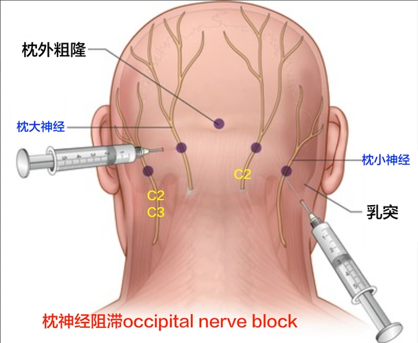 头痛不能都让颈椎病来背锅,有一种头痛 叫 "枕大神经痛"_枕神经痛_枕