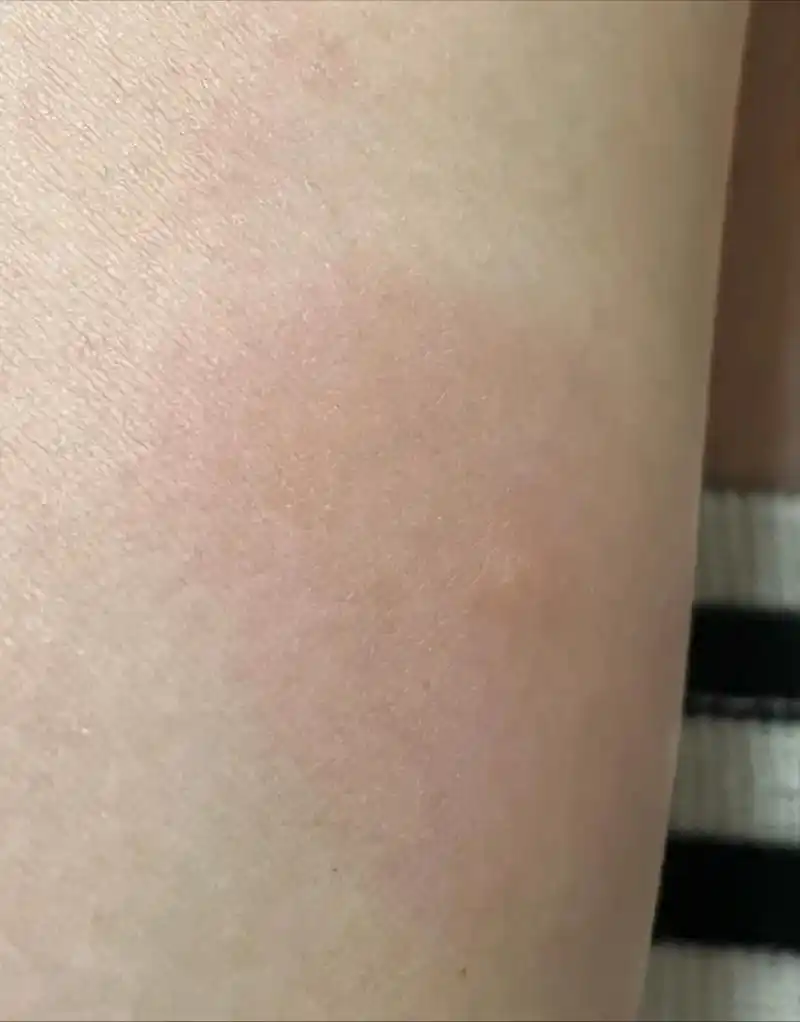 蚊子太毒了,咬完两天不下,硬疙瘩,里面有水,还大面积的肿,痒 - 抖音