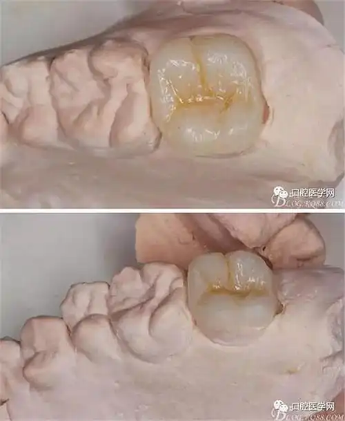 左上颌7牙髓炎一例 科贸嘉友收录