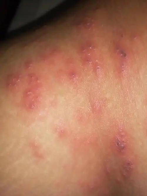 大腿内侧起红疹是什么原因