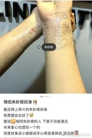 热点火出圈的朱砂痣不象征爱情而是你长了血管瘤