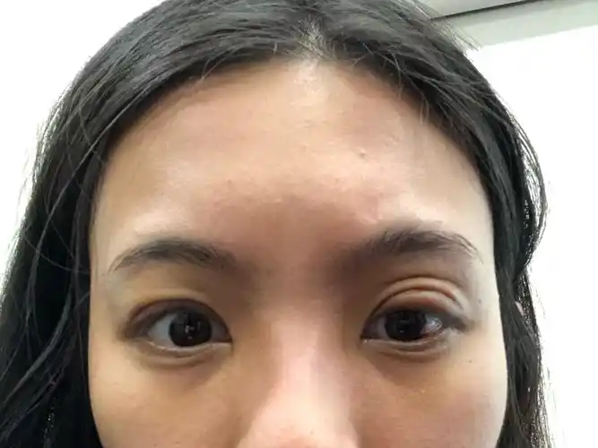 图中分自体脂肪填充眼窝一周后图片眼窝填充脂肪失败图片眼下凹陷图