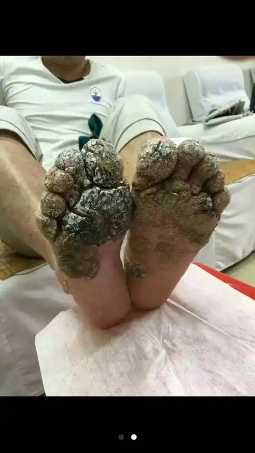 别把跎疣当鸡眼