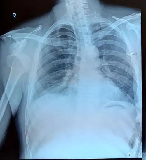 【原创病例讨论】:肩关节脱位