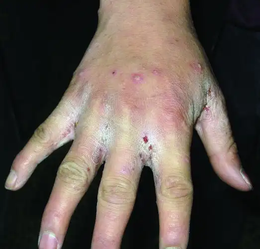 皮肤性病科图谱: 动物所致皮肤病 疥疮