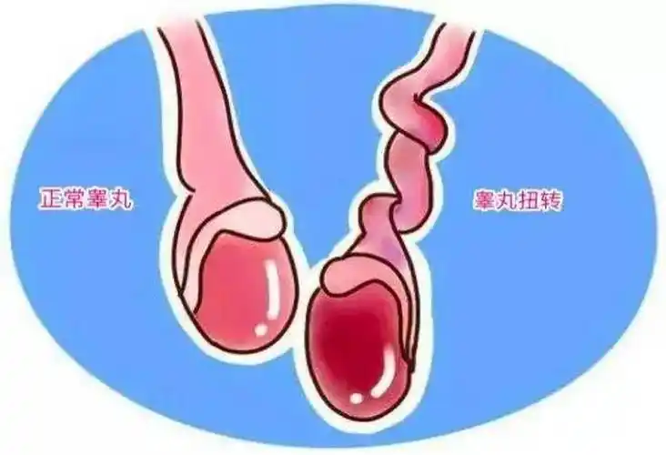 小心男宝宝睾丸扭转,抓住黄金急救6小时.