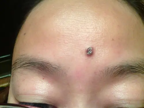 额头上黑痣发生变化,颜色和形状都有点,痣从小有,很大,是不是很严重?