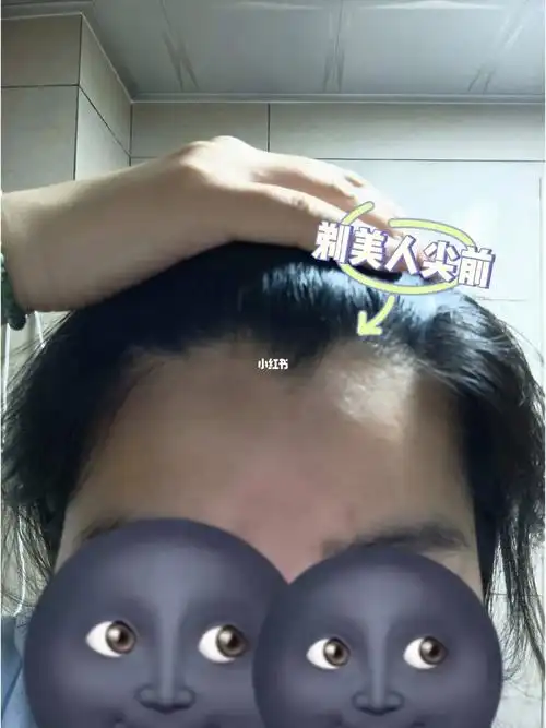 短额头的痛之剃发际线