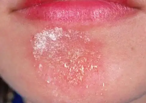 脸上长癣图片早期症状皮肤发红.脸上长癣图片脸颊大斑块.