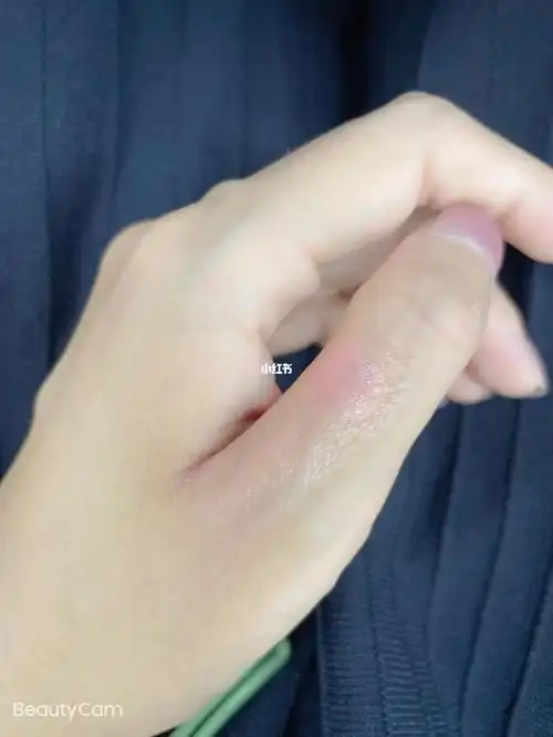 烫伤的手已经长好,通过这次烫伤让我发现了一个问题,我真的是从骨子里